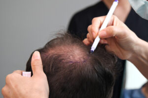 DHI HAIR TRANSPLANT 5 dhi hair transplant