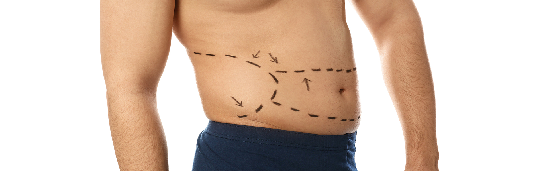 Male Vaser Liposuction