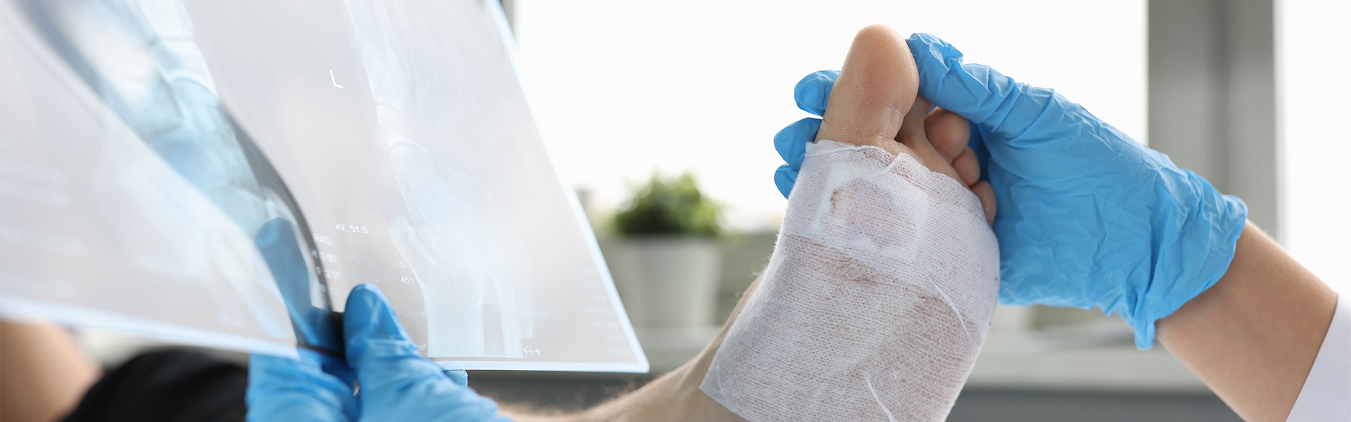 Toe Shortening Surgery in 3 Steps