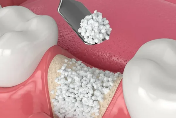 dental bone grafting