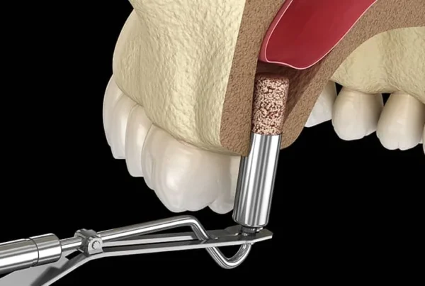 dental sinus lift