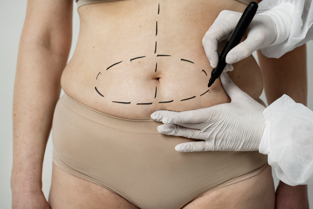 tummy tuck revision