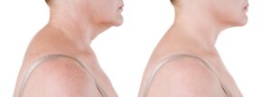 Goodbye Turkey Neck: Simple Steps to Tighten Skin 1 turkey neck
