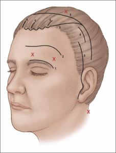 Diagram of brow-lifting incisions.