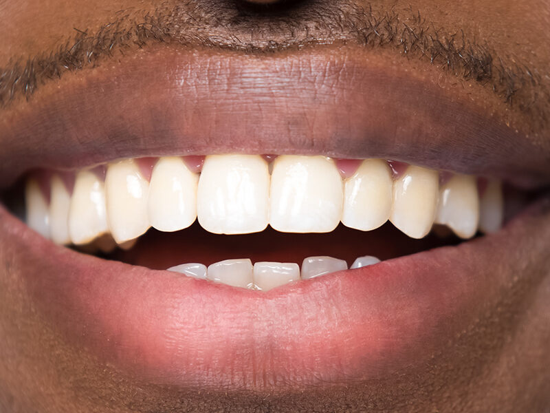 full mouth restoration with dental implants