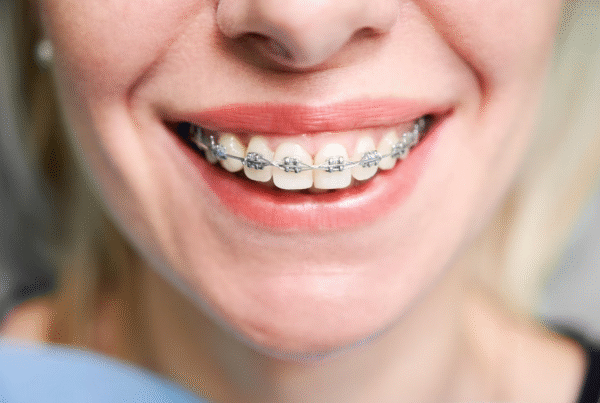 dental braces