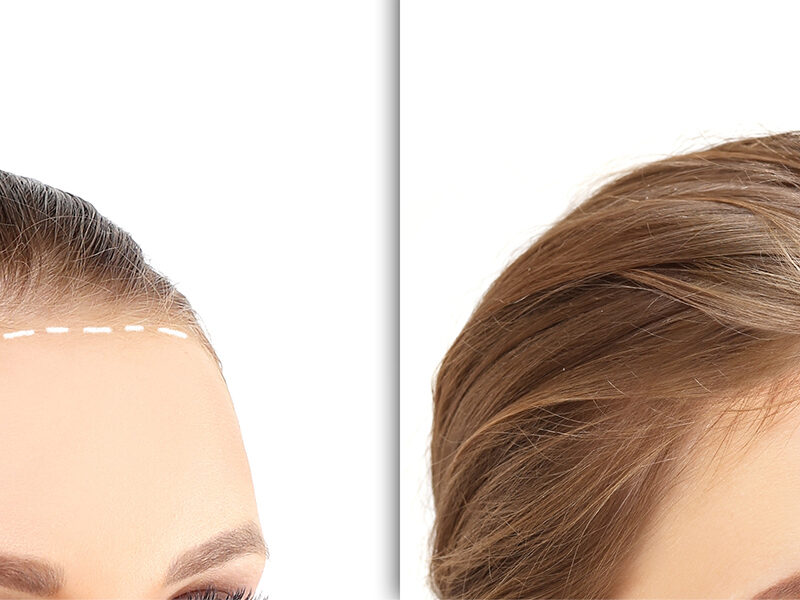female hair restoration