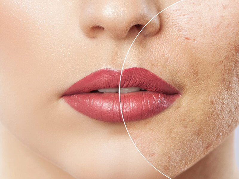 high intensity focused ultrasound