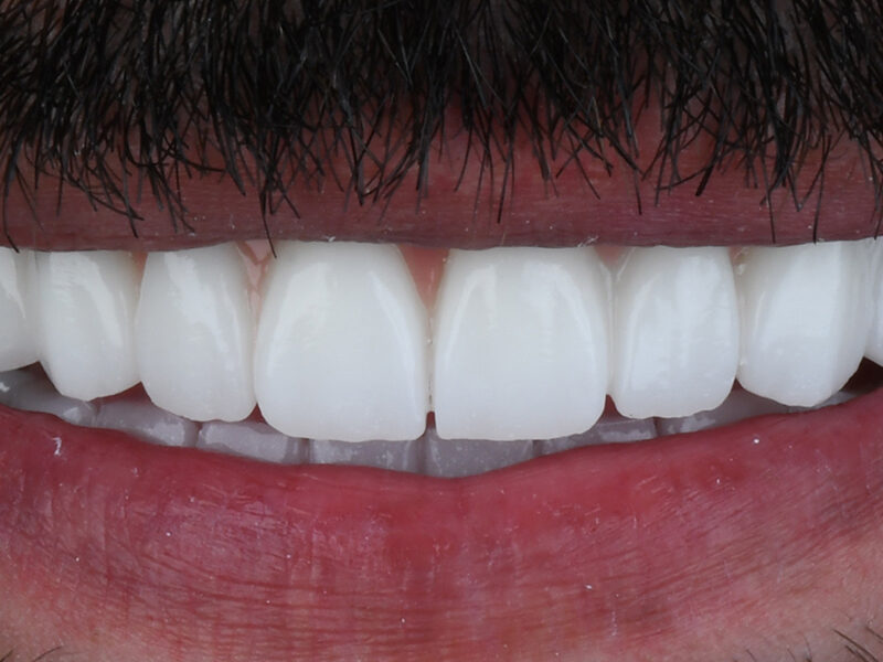 Full Smile Makeover with Porcelain Fused to Metal Crowns