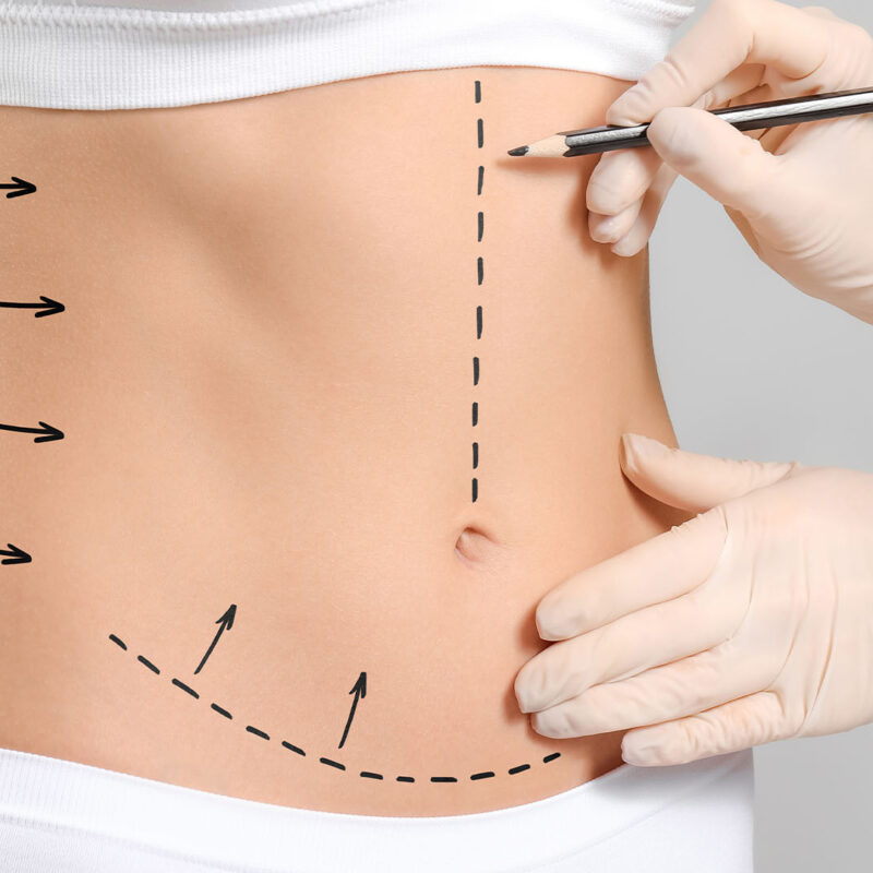 fleur de lis tummy tuck
