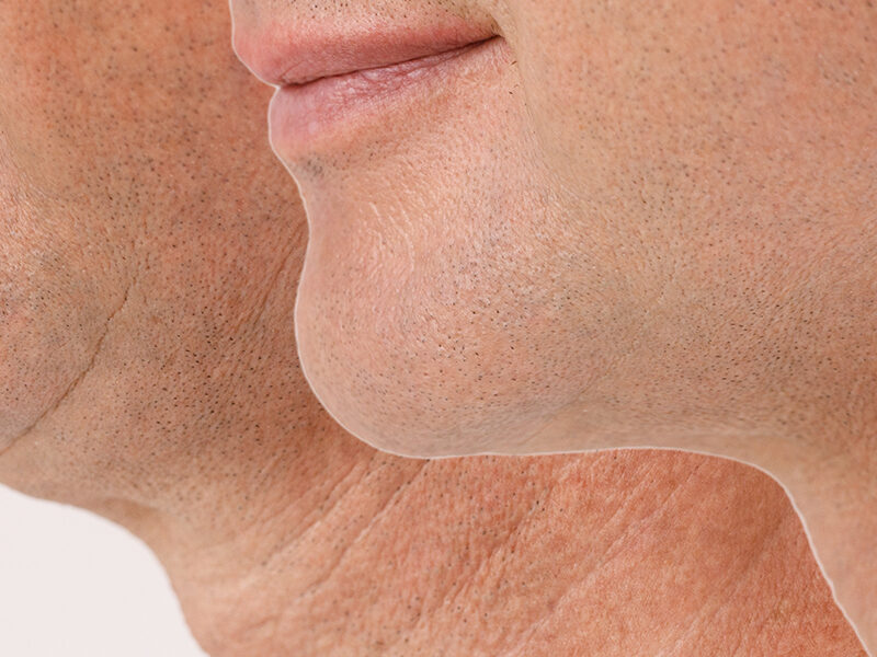 male chin implant