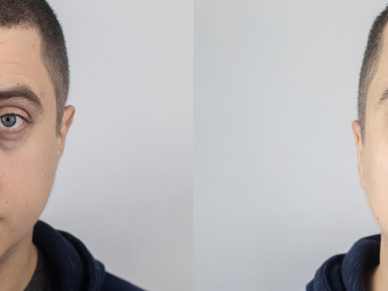 male eyebag removal surgery