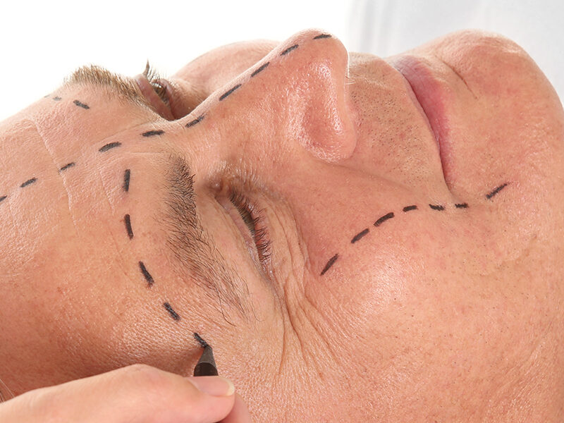 male facelift surgery